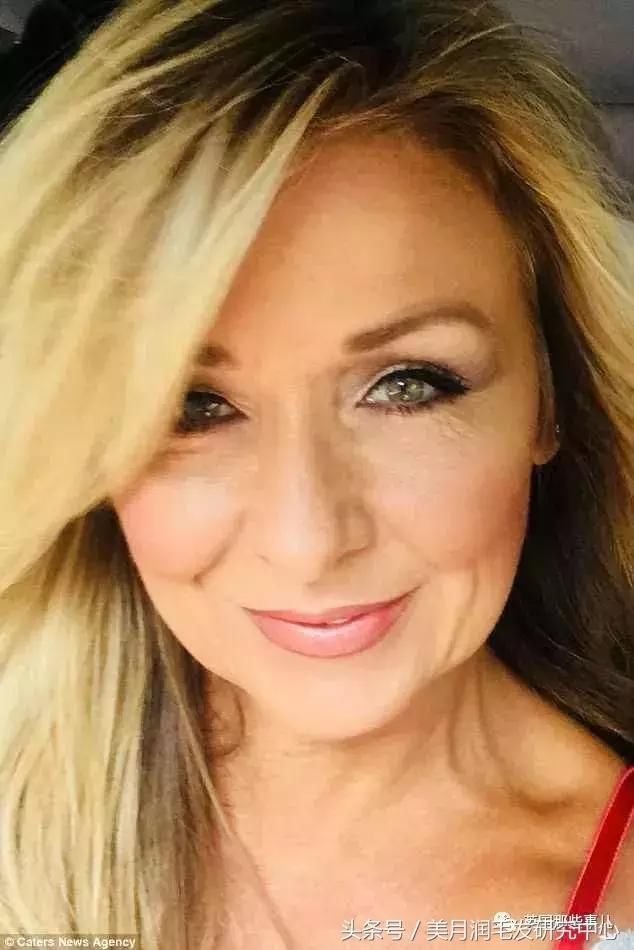 25年不卸妆!女子眼里长结石险失明