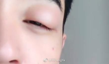 男星尴尬部位被蚊子咬后，导致整个剧组停工，网友：想上手摸一把