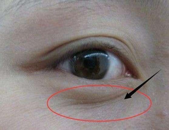 脂肪粒、眼袋救星!医学院博士说漏嘴的药膏!满满胶原蛋白