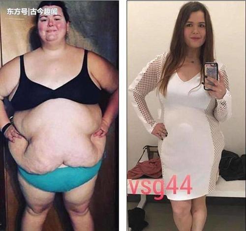 350斤胖妞减掉一半多体重，肚子留下20斤重的赘皮后悔不已！
