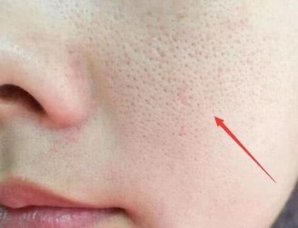 脸上毛孔被螨虫“堵住了”,会具备3个特征,别等烂脸后才后悔