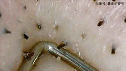 鼻子上为什么会有黑头？本文黑头图片高能警报，没做好准备勿看！