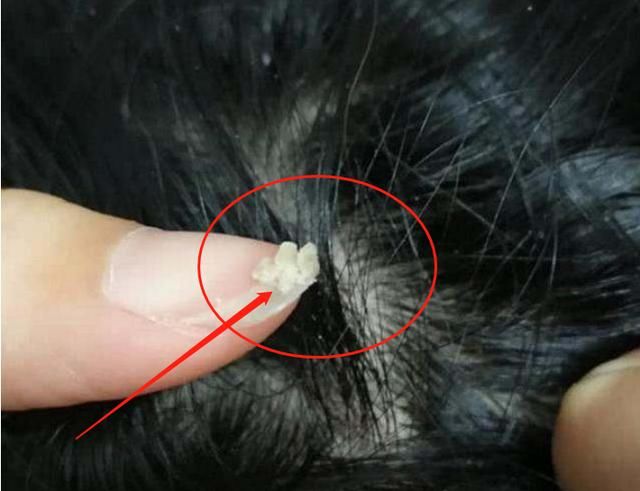 头上螨虫过亿,除了去医院,谨记2方法逼退螨虫!