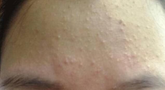 脸上爱长“白色颗粒”，说明上万螨虫挖开毛孔，简单去除只需3招