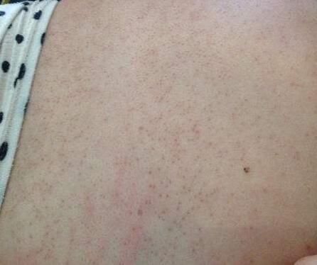 后背有痘痘需要除螨，及早知道2招能“消灭”