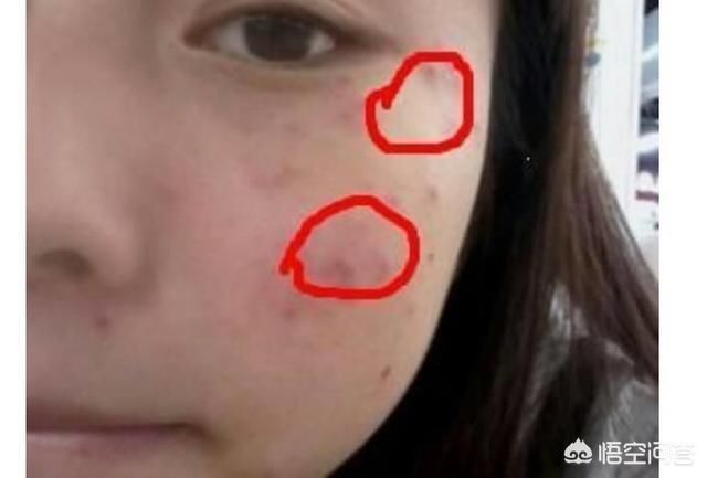 隐形的脸上“杀手” 如何才能彻底脸上螨虫?教你一小妙招