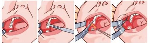 去颊脂垫术后脸部会凹陷吗？