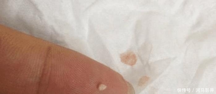 水油平衡■抿紧下巴后突起的“白疙瘩”,千万要注意,这是螨虫的真身吗