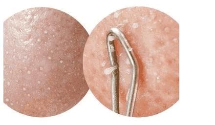 鼻子两侧挤出黄色条状物都逃不出这4种，总有一种符合你，2招吸净