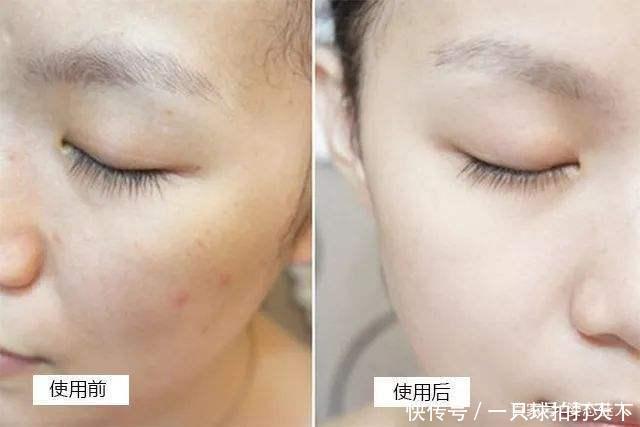  『恢复』皮肤有痘有色斑，赶紧把“花椒”用起来，15天便可恢复肌肤白净！