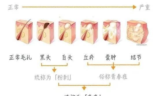  皮肤：鼻子上黑头泛滥？千万别用错方法，不仅没用还毁脸