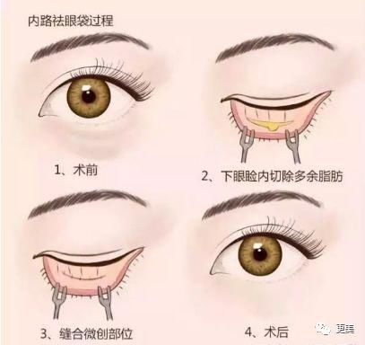 90后的郑爽关晓彤眼袋都要掉地上了，快来个医生救救她们吧!