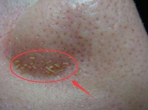 鼻头里的白条是螨虫吗？看这里，1眼辨别！