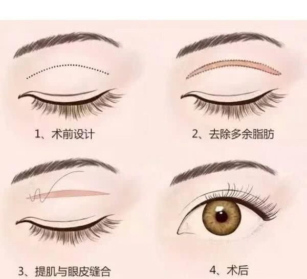  「科普」五种眼部问题科普解析，让你一双眼睛改变一张脸