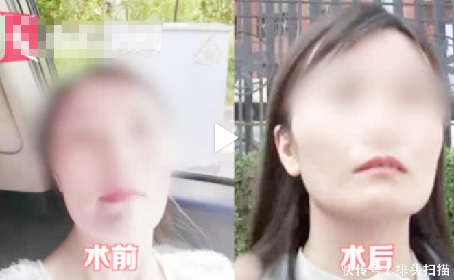  #填充#脸太瘦不旺夫？女子花4万整容，腿部抽脂填充脸，结果留下4个坑