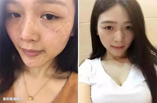 祛斑不在难，睡前红霉素加它擦脸，祛斑美白好多姑娘不知道