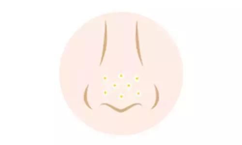 挤鼻子上的“小白点”时，挤出一个白色的长条是什么?