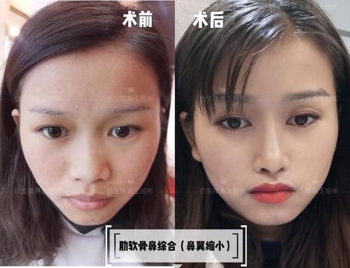  术后■鼻头肥大、山根低、没鼻梁，肋软骨隆鼻后变化有多大？