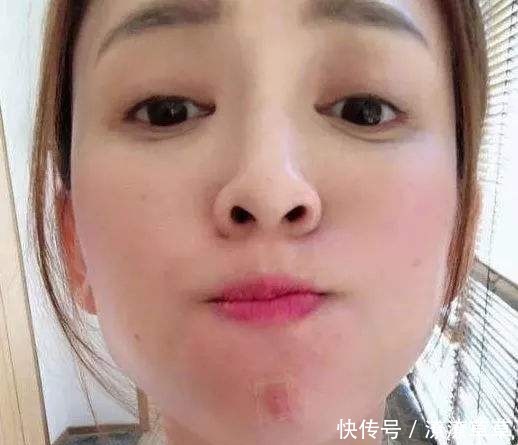  『皮肤』做错这3件事皮肤长痘的厉害，3个妙招让你变身无痘肌