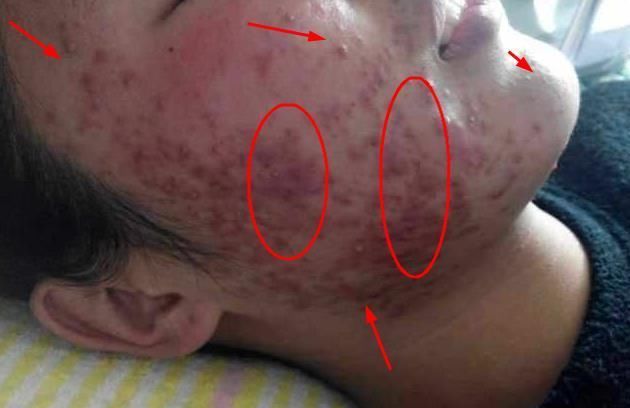 脸上的毛孔像一个个坑，说明过亿螨虫在爬钻咬，用这3招来“补救