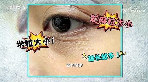 『护肤品』【快看·健康】眼周长脂肪粒是护肤品太过营养吗?