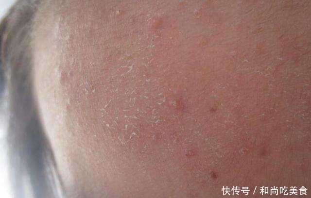 [干燥]春天肌肤出现起皮、爆痒、干燥，别对这些视而不见，为何这么干？
