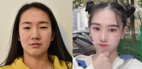  #术后恢复#为什么说春季是医美旺季？最适合整形项目大盘点，必看！