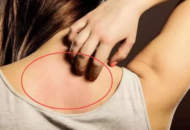 后背常有这3个表现，只要把堵毛囊的9层螨虫排出来，就会消失！