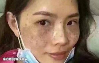 激光能祛斑?真傻!家里白色粉状物加水搅拌,一