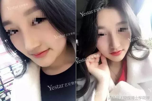 实锤：国民闺女，整容了？