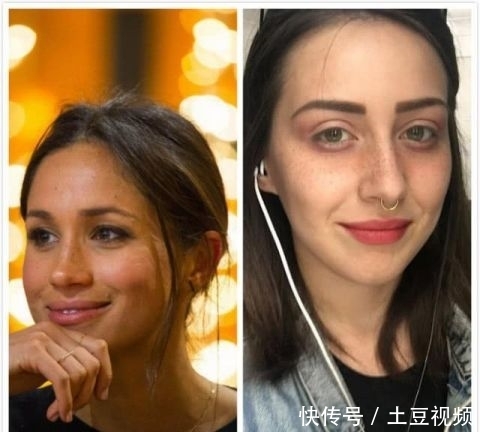  『手术』英女子痴迷梅根“雀斑妆”，拙劣手术让面部毁容，花3万治疗修复