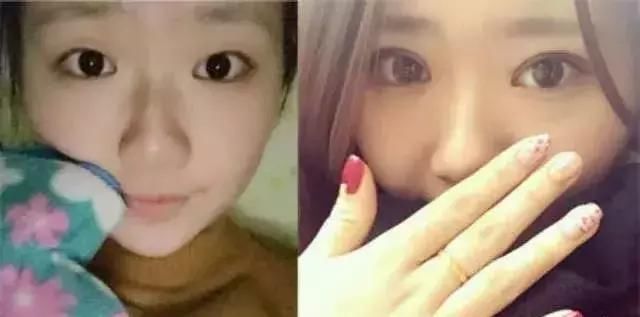 双眼皮+开眼角=我魅力大眼！