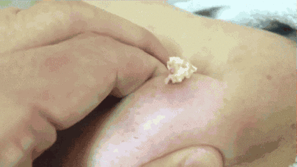 鼻子上为什么会有黑头？本文黑头图片高能警报，没做好准备勿看！