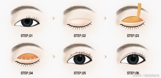 把单眼皮变成双眼皮，居然是这样做的