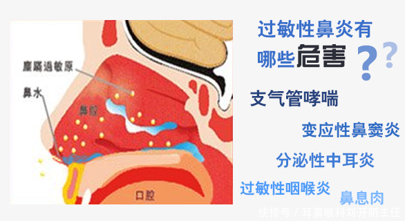 过敏性鼻炎的最佳治疗方法是什么