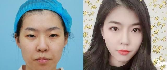  『影响』双眼皮术后恢复时间受哪些因素影响