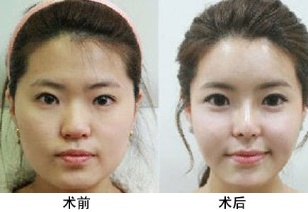 做假体隆鼻费用多少钱