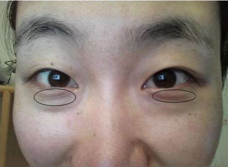 高龄皮肤主任告诉我:药店常见的药膏、用上3天，皱纹眼袋全消失