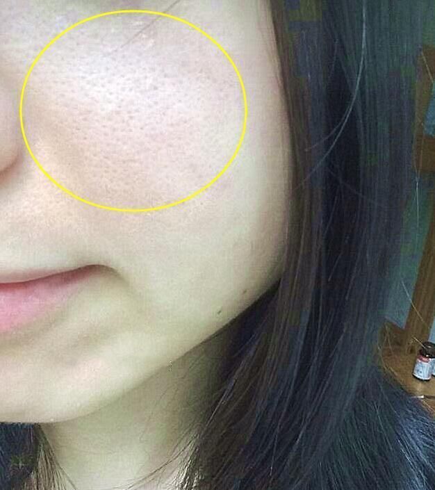 螨虫“打洞做窝”，毛孔粗成一个个洞，再不排螨，毛孔大大大