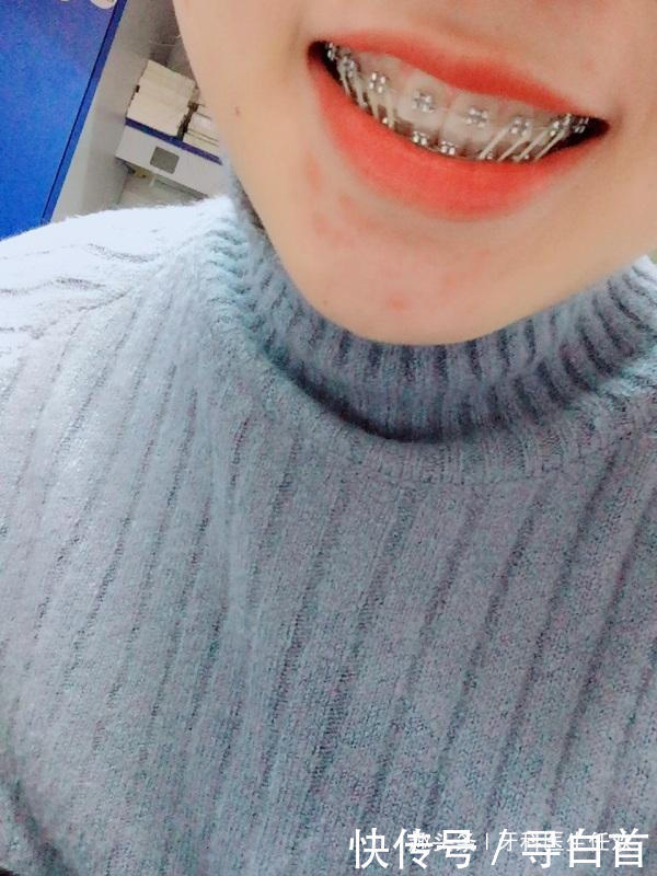 牙齿矫正期间戴橡皮筋有什么用