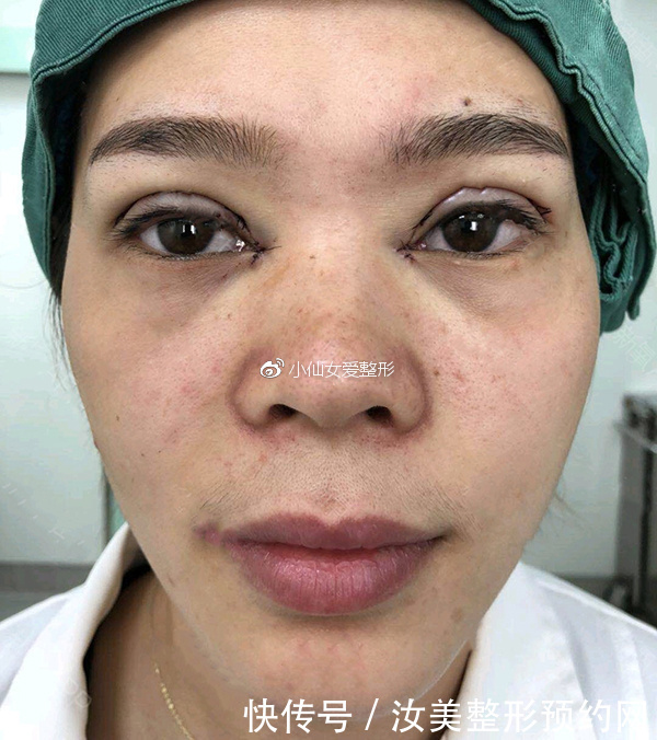 开内眼角前后对比照片，不灵不灵的大眼睛也着实的迷人