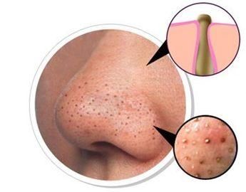 关于去黑头的皮肤管理知识！黑头不能挤？