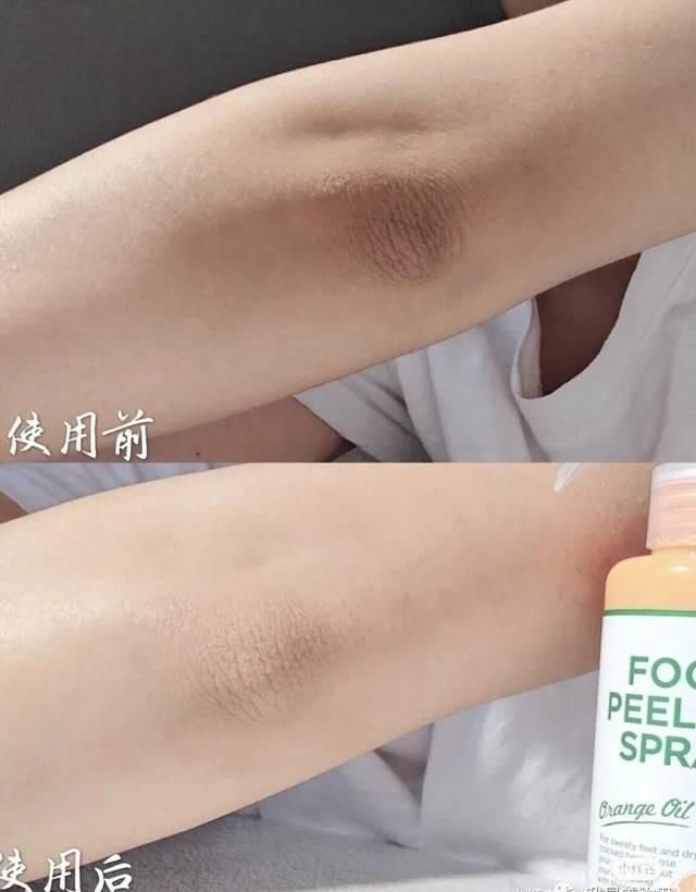 「jio」拯救脚后跟|凉鞋季马上来了,你的jio部护理开始做了吗?