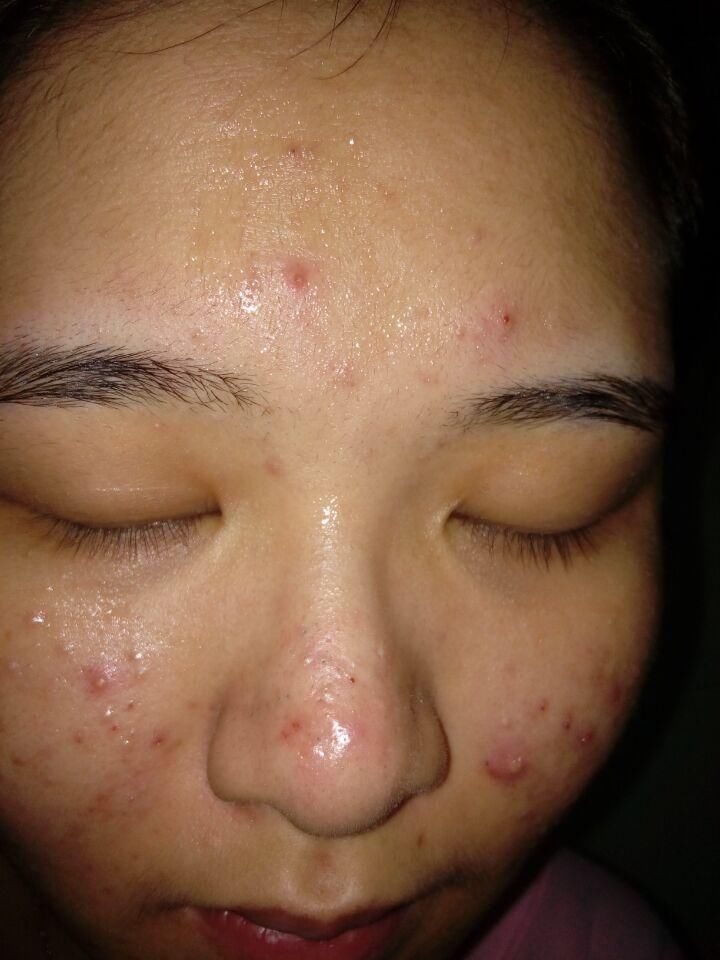 如何去除“闭口粉刺”