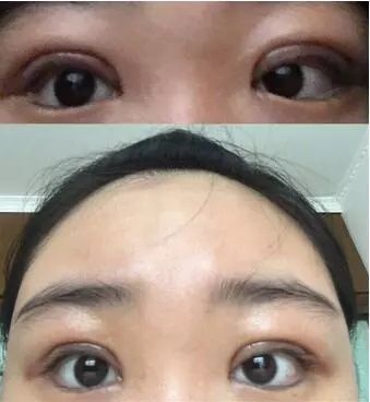 双眼皮一个月亲身经历，割对了双眼皮真的可以改变人生!