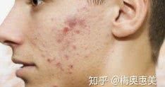  「正确」如何正确的祛痘痘