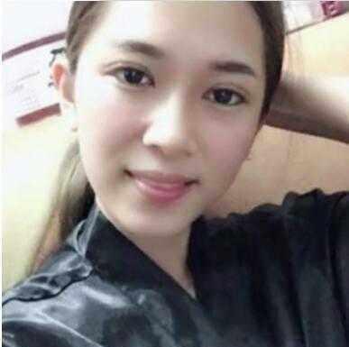 大眼睛美女做了双眼皮，男友说：恢复的挺不错的，越来越好看了