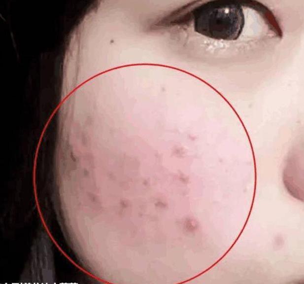 螨虫号称“皮肤田鼠”，脸上到底有没有，对照4道螨虫题一侧便知