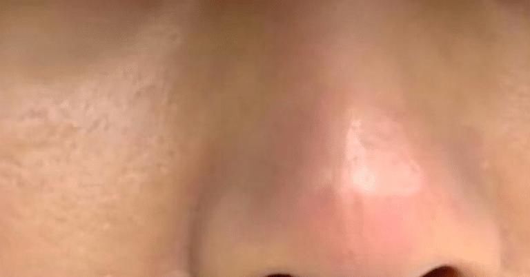  【术后】想要鼻子更秀气一点，术后竟然像“果冻”，女子吓得不敢出门