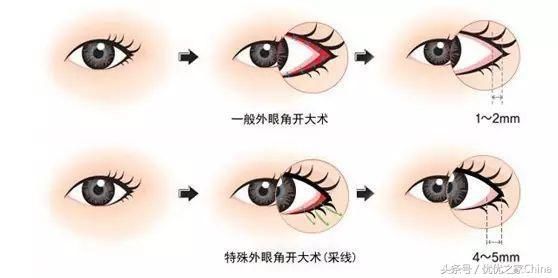 网红教科书：论斗鱼第一歌姬“冯提莫”和她的整容史